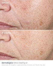 Load image into Gallery viewer, Dermalogica Acne Retinol Clearing Oil